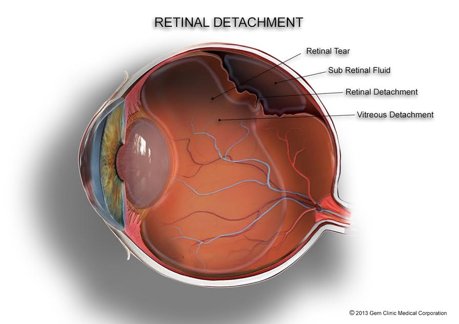 eye torn retina symptoms