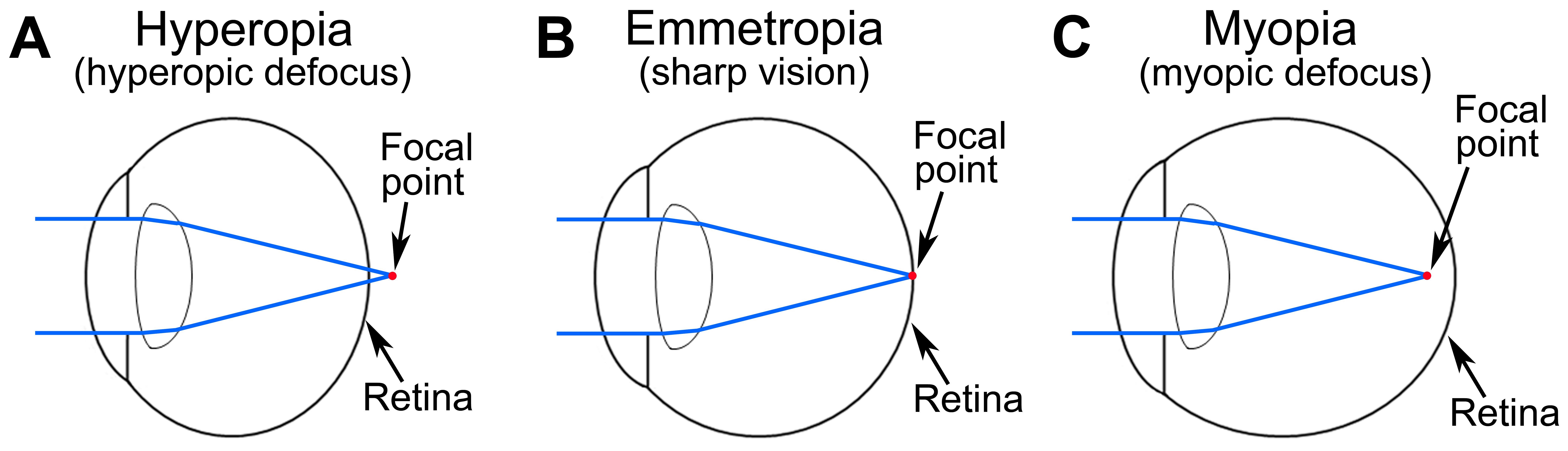 far point of eye