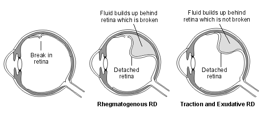 back-to-basics-retinal-detachment-sydney-ophthalmic-specialists