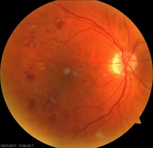 Fundus photo of a 55yo male which shows significant diabetic changes: cotton wool spots, dot and blot haemorrhages and hard exudates