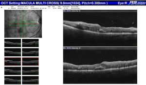 The OCT that corresponds with the above retinal photo demonstrates intra-retinal cysts and sub retinal fluid (diabetic macula oedema)