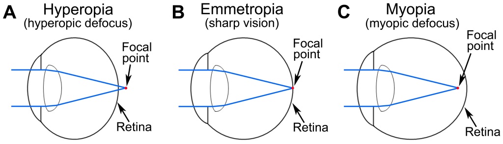 Hyperopia - Back To Basics - Sydney Ophthalmic Specialists