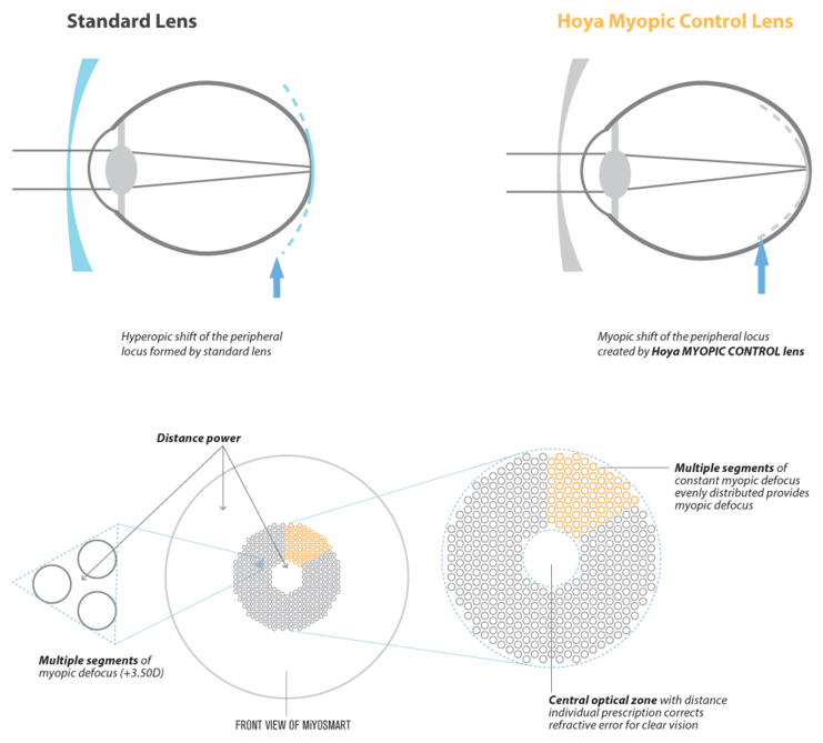 Image of the optical physics of a myopic eye being treated with a standard lens versus a DIMS lens.